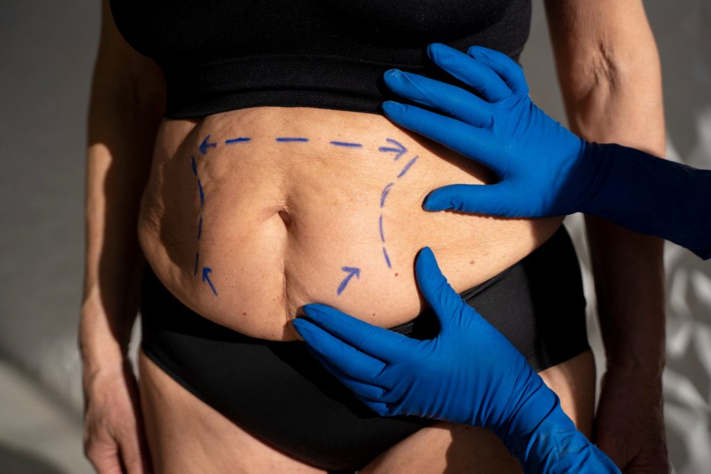 Descubra como reduzir riscos na lipoaspiração e evitar complicações